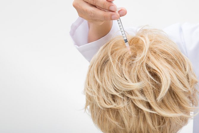 Mezohair (tratamentul împotriva alopeciei)