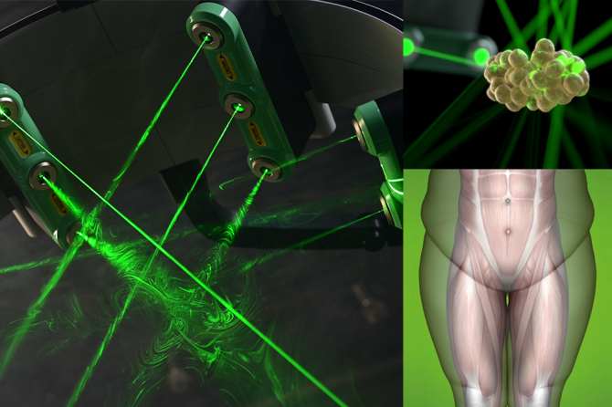 Ce trebuie sa stii despre laserul Emerald