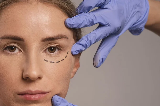 Blefaroplastia sau chirurgia pleoapelor